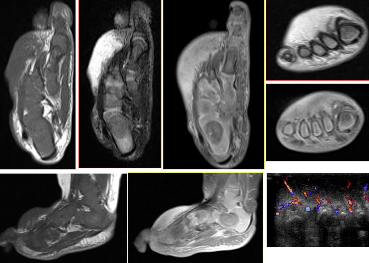 Figure 2 for case Milroys Disease